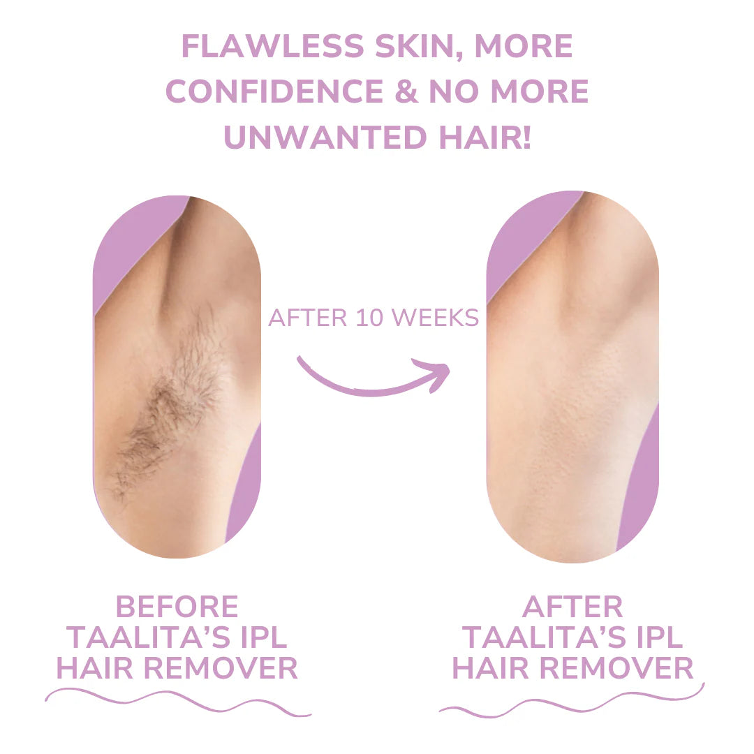 SilkGlow IPL™ Hair Removal Device